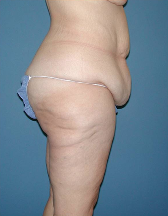 Body Lift before 529678
