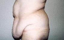 Body Contouring before 557016