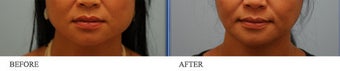 Botox Jaw Reduction before 445519