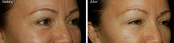 Botox for Crows Feet before 97875