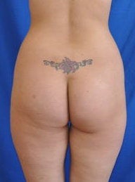 Brazilian Butt Lift before 256198