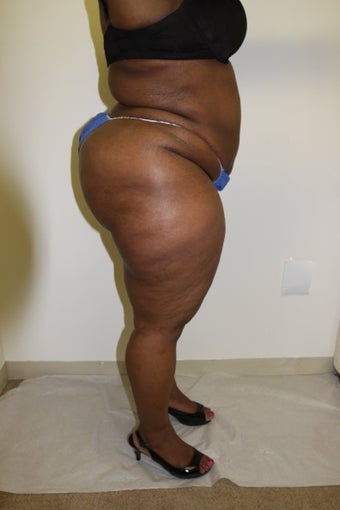 Brazilian Butt Lift after 483374