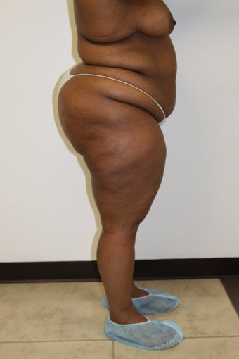 Brazilian Butt Lift before 483374