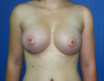 Breast Augmentation after 578454