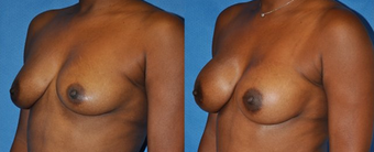 Flash Recovery Breast Augmentation TM before 253895