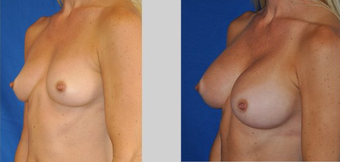 Flash Recovery Breast Augmentation TM before 253991