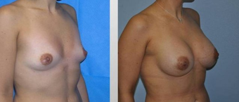 Breast Augmentation before 256385