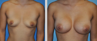 Flash Recovery Breast Augmentation (TM) before 256399