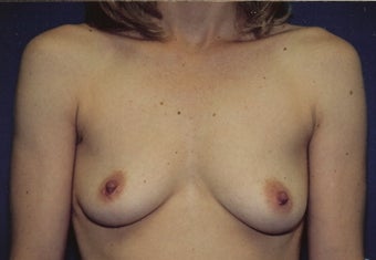 Breast Augmentation before 266777