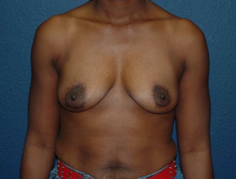 Breast Augmentation before 575278