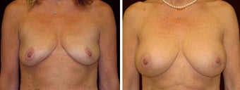 45 year old female, breast augmentation, San Francisco, California before 628359