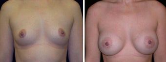26 year old female, breast augmentation San Francisco, California before 628374