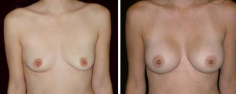 27 year old female, breast augmentation, San Francisco, California before 628393