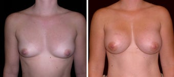 29 year old female, breast augmentation, San Francisco, California before 628403