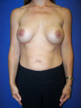 Breast Implant Revision before 123402