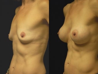Breast augmentation, gel implants after 462159