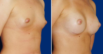 Breast Implants after 494483