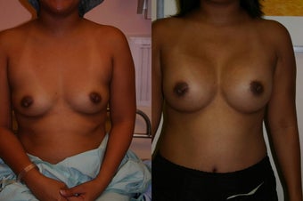 Breast augmentation before 138370