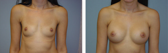 Breast augmentation with breast implants before 259915