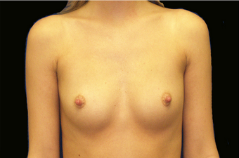 Breast Augmentation before 335974