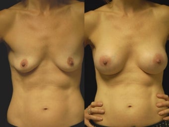 Breast augmentation, gel implants before 462159