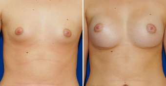 Breast Implants before 494483