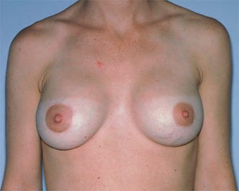 Breast Lift after 285335