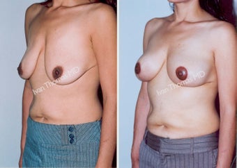 Mastopexy-Breast Lift before 243708