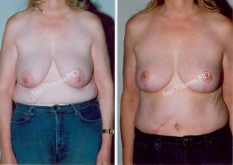 Mastopexy-Breast Lift before 243716