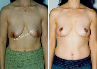 Mastopexy-Breast Lift before 243719