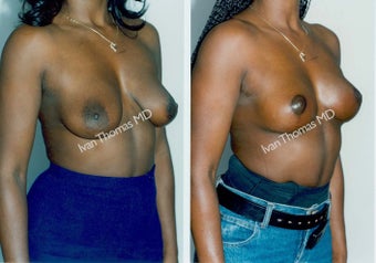 Mastopexy-Breast Lift before 243721