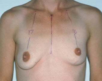 Breast Lift before 285335