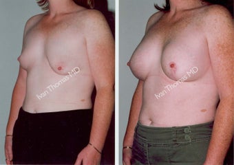 Breast Reconstruction before 243026