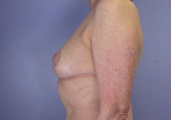 Breast Reduction after 285325