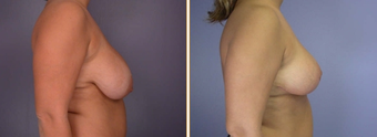 Breast Reduction & Lift before 270052
