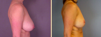 Breast Reduction before 271113