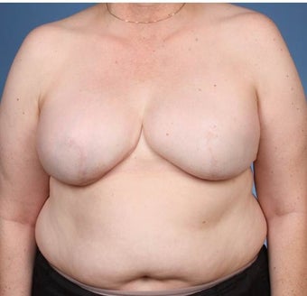 Breast Reconstruction after 519678