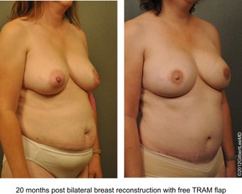 Breast Reconstruction after 529310