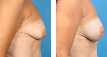 Breast Reconstruction: One-Stage Breast Reconstruction after 561811