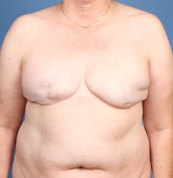 Breast Reconstruction before 519678