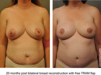 Breast Reconstruction before 529310