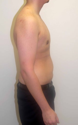 Gynecomastia after 351837