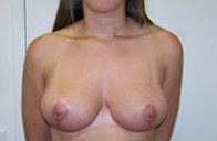 Breast Reduction after 370601