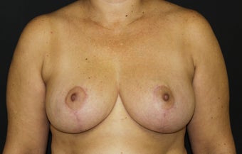 Breast Reduction after 491208