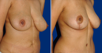 Breast Reduction after 495860