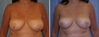 53 years old / breast reduction vertical technique before 343928