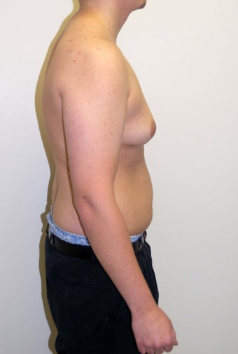 Gynecomastia before 351837