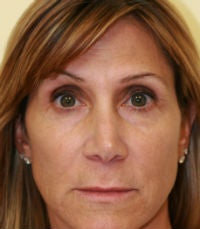 Forehead Lift (browlift) before 269103