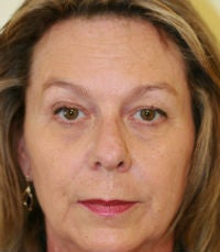 Forehead Lift (browlift) before 269119