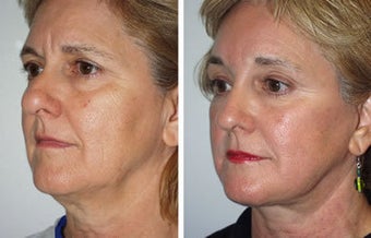 Brow Lift before 91507